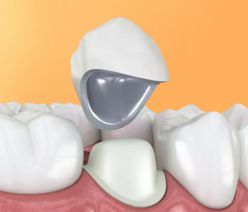 Răng sứ kim loại: Ưu điểm, nhược điểm và những điều bạn cần biết